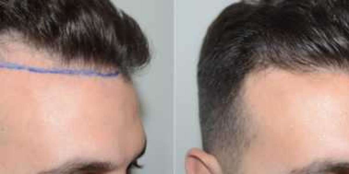 Male Hairline Lowering Surgery