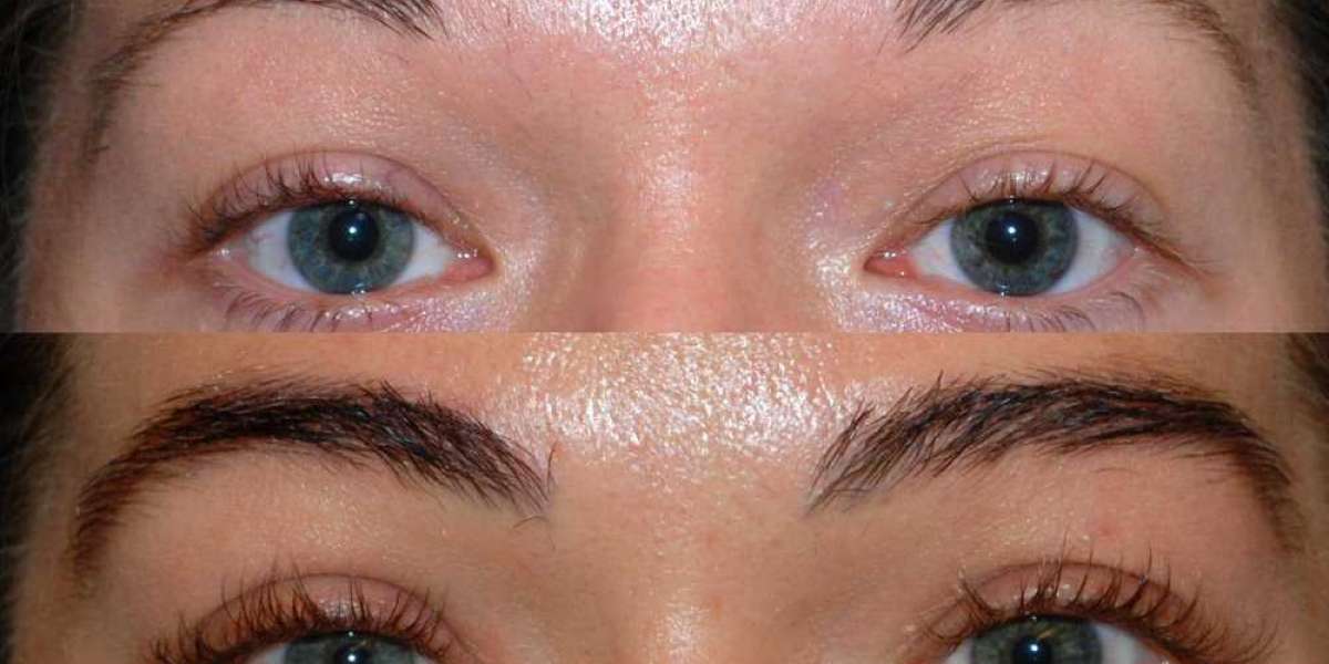 Eyebrow Restoration Treatment