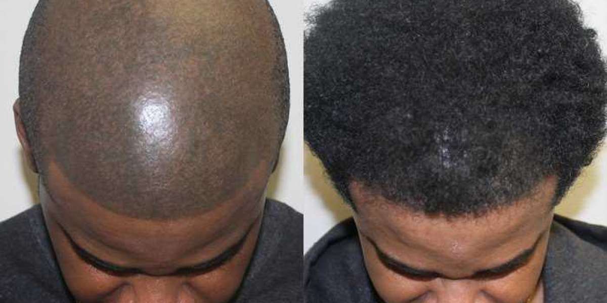 What Are the Costs of an African American Hair Transplant Treatment?